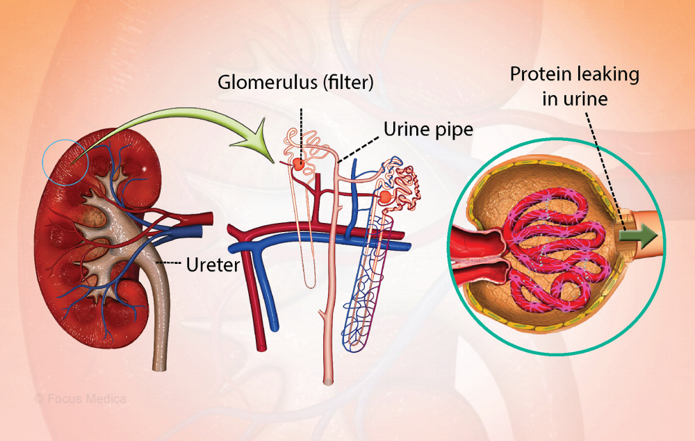 Nephrotic syndrome is a kidney disorder in which too much protein is passed in the urine, resulting in puffiness over the face, and tiredness.